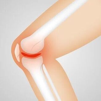 osteoarthritis is a non-inflammatory joint pathology